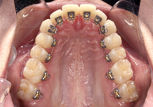 Lingual Braces